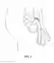 Fig. 04 - OCCLUSION IMPLANT