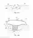 Fig. 14 - Negative pressure wound closure devices and methods