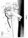 Fig. 41 - ADJUSTABLE POSITION LIMB SUPPORT FOR SURGICAL TABLES