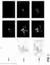 Fig. 11 - Composition for treating cancerous cells and a method therefor
