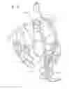 Fig. 10 - Ventricular assist device for intraventricular placement
