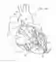 Fig. 11 - Ventricular assist device for intraventricular placement