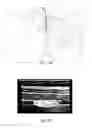 Fig. 06 - Continuous Transversus Abdominis Plane Block