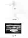 Fig. 07 - Continuous Transversus Abdominis Plane Block