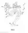 Fig. 03 - Carotid artery occluding apparatus with first and second occluding balloons