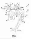 Fig. 04 - Carotid artery occluding apparatus with first and second occluding balloons