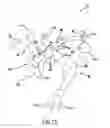 Fig. 11 - Carotid artery occluding apparatus with first and second occluding balloons