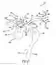 Fig. 13 - Carotid artery occluding apparatus with first and second occluding balloons
