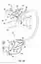 Fig. 14 - Carotid artery occluding apparatus with first and second occluding balloons