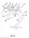 Fig. 15 - Carotid artery occluding apparatus with first and second occluding balloons