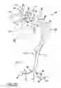 Fig. 16 - Carotid artery occluding apparatus with first and second occluding balloons