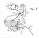 Fig. 07 - SINUS STENT