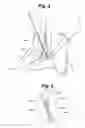 Fig. 06 - Electrical stimulation for preservation and restoration of diaphragm function