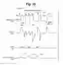 Fig. 13 - Electrical stimulation for preservation and restoration of diaphragm function