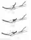Fig. 12 - SURGICAL TOOLS AND METHODS FOR DELIVERING A NEUROSTIMULATOR INTO THE PTERYGOPALATINE FOSSA