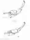 Fig. 30 - SURGICAL TOOLS AND METHODS FOR DELIVERING A NEUROSTIMULATOR INTO THE PTERYGOPALATINE FOSSA