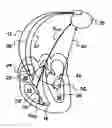 Fig. 01 - Active implantable medical device for detecting and quantifying fusion