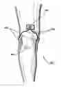 Fig. 01 - Apparatus and method for electromagnetic treatment of neurological injury or condition caused by a stroke