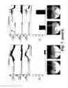 Fig. 09 - Magnetic stimulation of the spinal cord to restore control of bladder and/or bowel