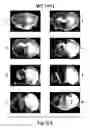 Fig. 69 - Methods for Treating Conditions Associated with MASP-2 Dependent Complement Activation