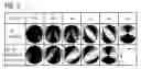 Fig. 06 - Magnetic sensor device having a magneto-resistive structure that generates a vortex magnetization pattern