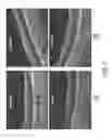 Fig. 08 - OPTICAL COHERENCE TOMOGRAPHY GLAUCOMA DETECTION BASED ON RETINAL VESSEL RELIEF HEIGHT