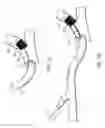 Fig. 05 - ENDOBRONCHIAL BRUSH DEVICE TO ESTIMATE SIZE OF AIRWAYS