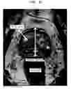 Fig. 12 - Prostate glove, fingertip optical encoder, connector system, and related methods
