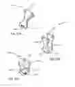 Fig. 23 - LATERAL ACCESS SYSTEM FOR THE LUMBAR SPINE