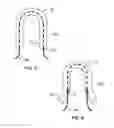 Fig. 06 - HYBRID SUTURE ANCHOR