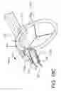 Fig. 23 - Prosthetic suturing device and methods thereof