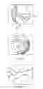 Fig. 06 - Arthroscopic surgery method for ankle impingement