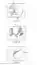 Fig. 08 - Arthroscopic surgery method for ankle impingement