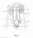 Fig. 02 - Calculus retrieving/removing device and method