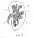 Fig. 16 - Calculus retrieving/removing device and method