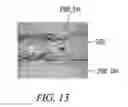 Fig. 10 - Clot retrieval system