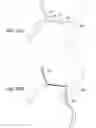 Fig. 100 - Clot retrieval system