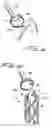 Fig. 07 - Vacuum assisted surgical dissection tools