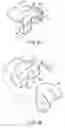 Fig. 04 - Method for replacement arthroplasty