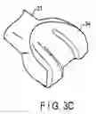 Fig. 05 - Method for replacement arthroplasty