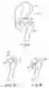 Fig. 08 - Method for replacement arthroplasty