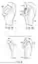 Fig. 09 - Method for replacement arthroplasty