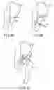 Fig. 10 - Method for replacement arthroplasty