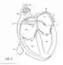 Fig. 03 - Valve treatment by injection