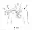 Fig. 02 - Medical device for removing an implanted object