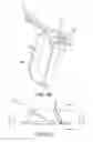 Fig. 06 - Medical device for removing an implanted object