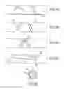 Fig. 08 - Medical device for removing an implanted object
