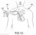 Fig. 15 - Medical device for removing an implanted object