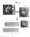 Fig. 03 - Spatial visualization of internal mammary artery during minimally invasive bypass surgery