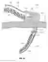 Fig. 14 - MAGNETICALLY COUPLING DEVICES FOR MAPPING AND/OR ABLATING